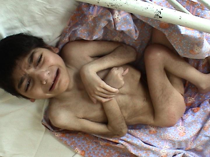an emaciated child laying down on a blanket