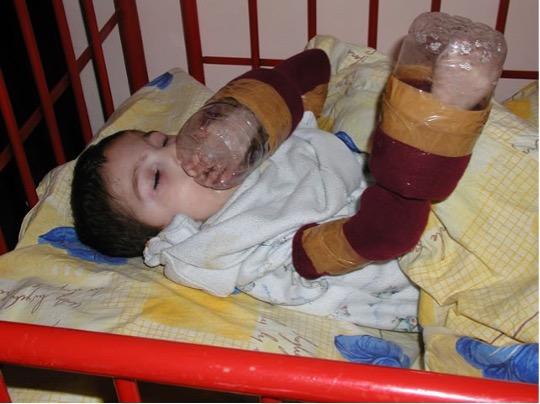 a child in a crib with plastic bottles taped to their hands